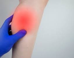 Gurgaon, Businesses For Sale, Calf Strain Physiotherapy In Gurgaon &ndash; Effective Pain Relief & Fast Recovery