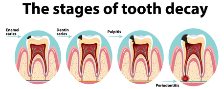 Mumbai, Health, Early Signs Of Tooth Decay You Should Never Ignore