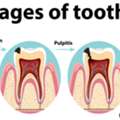 Early Signs Of Tooth Decay You Should Never Ignore