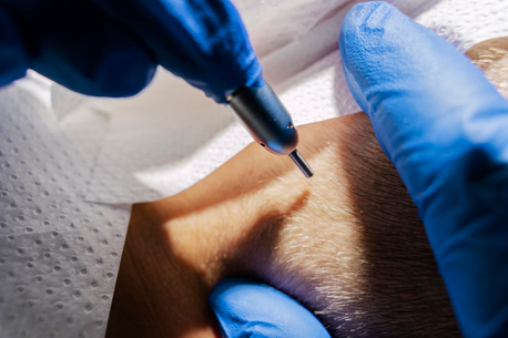 Manchester, Beautician, The Best UK Hair Transplant Clinic In London, Leeds & Manchester
