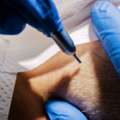 The Best UK Hair Transplant Clinic In London, Leeds & Manchester