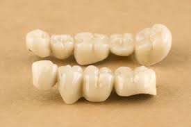 Singapore, Dental, Mastering Your Smile: Hawley Retainer