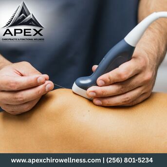 Kabul, Health, Dry Needling In Hampton Cove | Apex Chiropractic & Functional Wellness