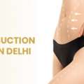 Advanced Liposuction Surgery In Delhi | Langersculpt
