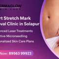 Professional Stretch Mark Treatment In Solapur | Expert Skin Specialists