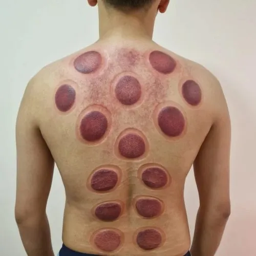 Riyadh, Items Wanted, Hijama (Cupping Therapy)