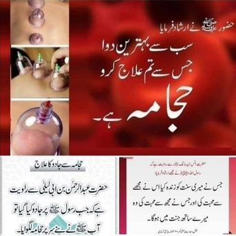 Riyadh, Guides/Interpreters, Hijama (Cupping Therapy) The Best Treatment For Cleansing Your Body & Soul.