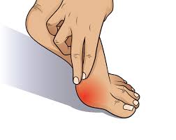 Singapore, Health, How Non-Invasive Bunion Surgery Can Transform Your Life