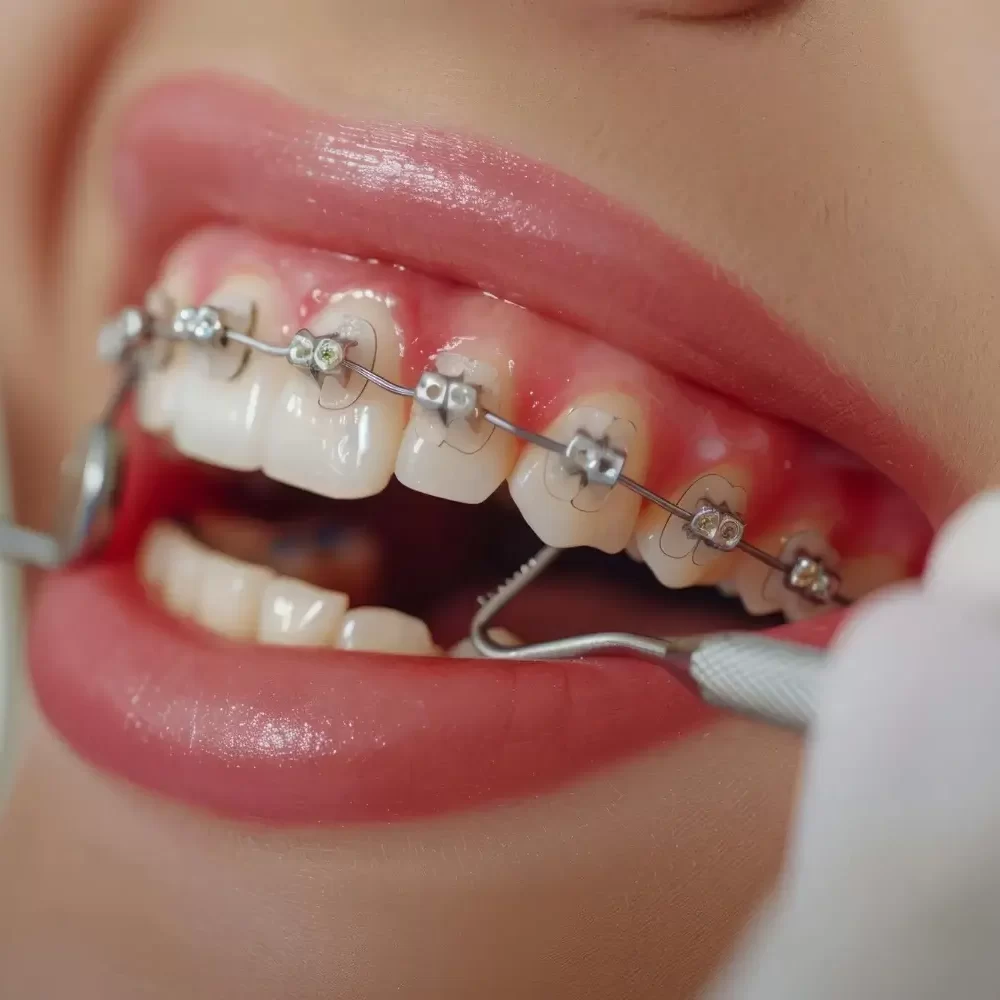 New Delhi, Health, Dental Braces Specialist In East Delhi