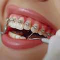 Dental Braces Specialist In East Delhi