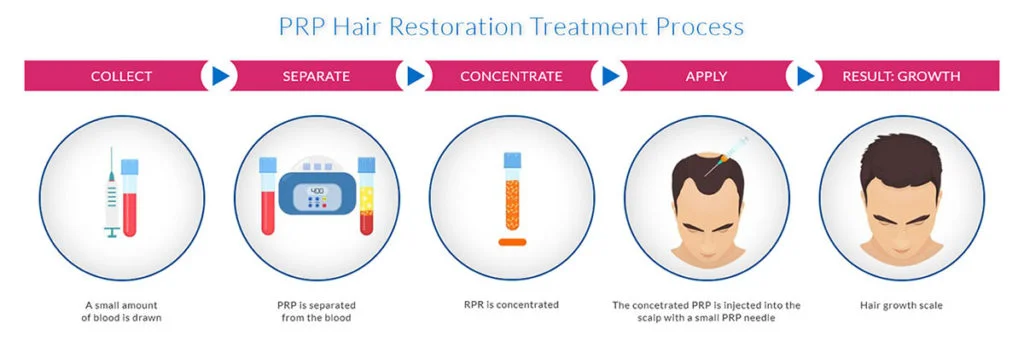 Ahmedabad, Health, Platelet Rich Plasma Treatment In Ahmedabad For Natural Hair Regrowth