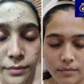 Professional Anti Ageing Skin Care Services In Thane | DNA Royal.