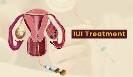 Ahmedabad, Health, Advanced IUI Treatment In Ahmedabad By Fertility Experts