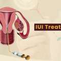 Advanced IUI Treatment In Ahmedabad By Fertility Experts