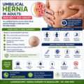 Umbilical Hernia In Adults: When Does It Need Surgery?