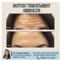 Botox Results At Dermacure Clinic - Rajahmundry