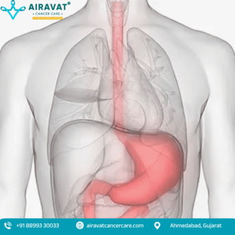 Ahmedabad, Health, Stomach Cancer Hospital In Ahmedabad &ndash; Airavat Cancer Care