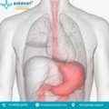 Stomach Cancer Hospital In Ahmedabad &ndash; Airavat Cancer Care