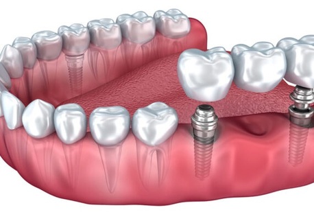 Gurgaon, Dental, Top Dentist In Gurgaon - Dr. Manoti Sehgal