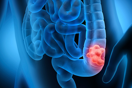 Ahmedabad, Health, Best Colon Cancer Treatment In Ahmedabad With Expert Oncologists