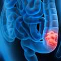 Best Colon Cancer Treatment In Ahmedabad With Expert Oncologists