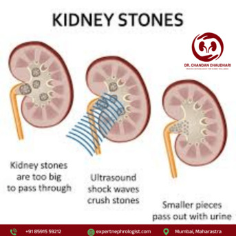 Mumbai, Health, Kidney Stone Treatment In Mumbai For Better Kidney Health