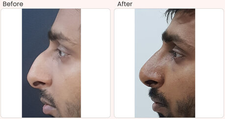 New Delhi, Health, Nose Surgery Cost In Delhi - Dr Rajat Gupta