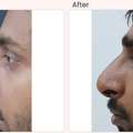 Nose Surgery Cost In Delhi - Dr Rajat Gupta