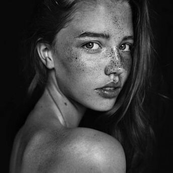 Toronto, Health, Repair Sun-Damaged Skin With Advanced Sun Damage Treatment Toronto
