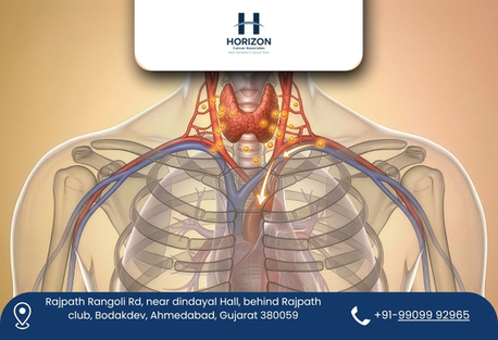 Ahmedabad, Health, Innovative Thyroid Cancer Treatment With Precision Care