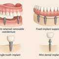 How Painful Is A Denture Implant Procedure?