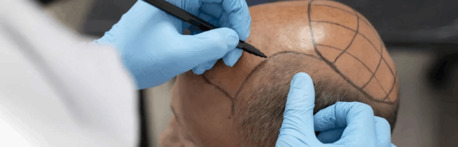 Gurgaon, Health, Get Permanent Hair Transplant In India At SB Aesthetics