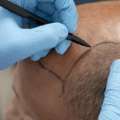 Get Permanent Hair Transplant In India At SB Aesthetics