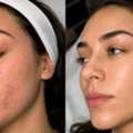 GBP 400,  Microneedling Before And After: What Results Can You Expect?