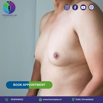 Ahmedabad, Health, Gynecomastia Correction In Ahmedabad At Kosmo Plus Hospital
