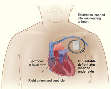 Abu Dhabi, Health, ICD Surgery In Abu Dhabi | Advanced Cardiac Care At The Heart.ae
