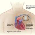 ICD Surgery In Abu Dhabi | Advanced Cardiac Care At The Heart.ae