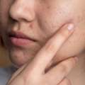 Lightweight Acne Control Serum For Daily Skin Care