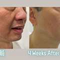 CAD 1000,  Sofwave Treatment In Richmond Hill