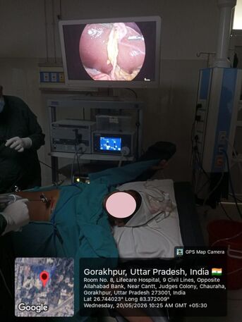 Lucknow, Health, Free Laparoscopic Gallbladder Surgery Brings Relief To West Champaran Woman