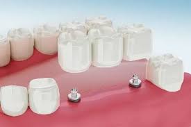Singapore, Dental, Tooth Or Dare: Dental Crown Procedure