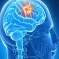 Brain Surgery In Bangalore