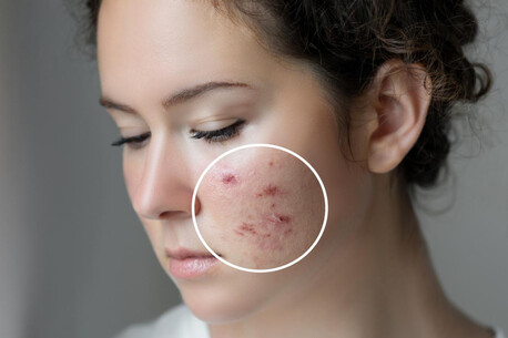 Noida, Health, Best Acne Scar Treatment In Noida By Expert Dermatologists