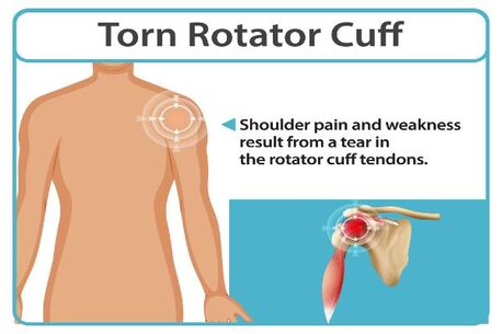 New York, Medical, Shoulder Pain? Discover Why A Rotator Cuff Specialist May Matter
