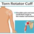 Shoulder Pain? Discover Why A Rotator Cuff Specialist May Matter