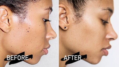 New York, Health, Dermatosis Papulosa Nigra Treatment Tampa Experts
