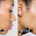 Dermatosis Papulosa Nigra Treatment Tampa Experts