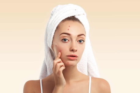 Bangalore, Health, Summer Skincare Tips For Acne-Prone Skin &mdash; Suggest