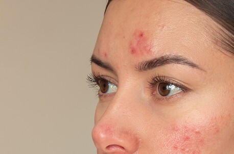 New York, Health, Lightweight Daily Glow Support For Breakout-Prone Skin