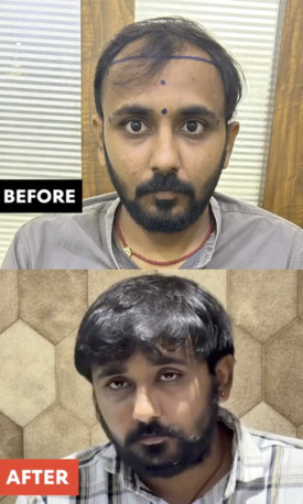 Ahmedabad, Health, Hair Transplant For Man In Ahmedabad